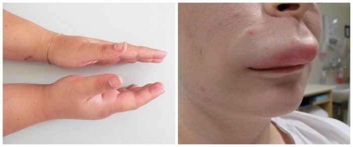 ביטויים חיצוניים של בצקת קווינקה