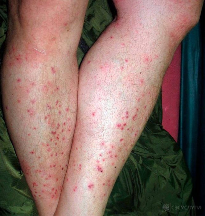 עקיצות פרעושים על הרגליים