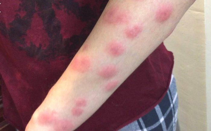 אַלֶרגִיָה