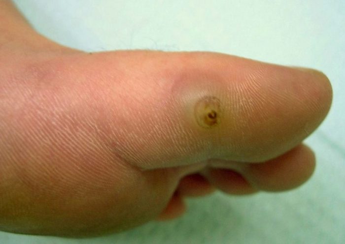 טונגיה על הבוהן