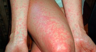 פריחה על הזרועות והרגליים