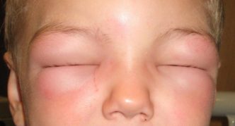 תסמינים של בצקת קווינקה על פניו של ילד