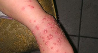 פפולות על הרגל