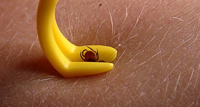 הקרציה מוסרת מהעור באמצעות מכשיר מיוחד.