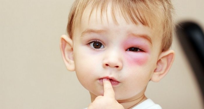 ילד עם נפיחות בעין