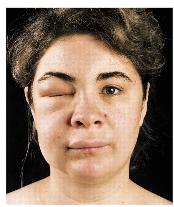 בצקת קווינקה