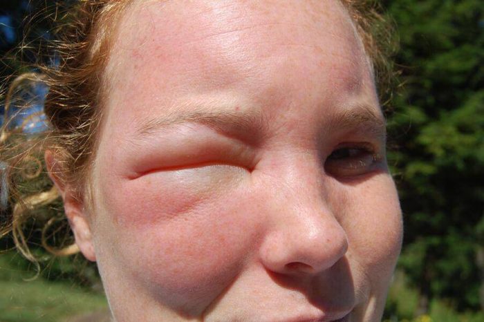 עקיצת דבורה