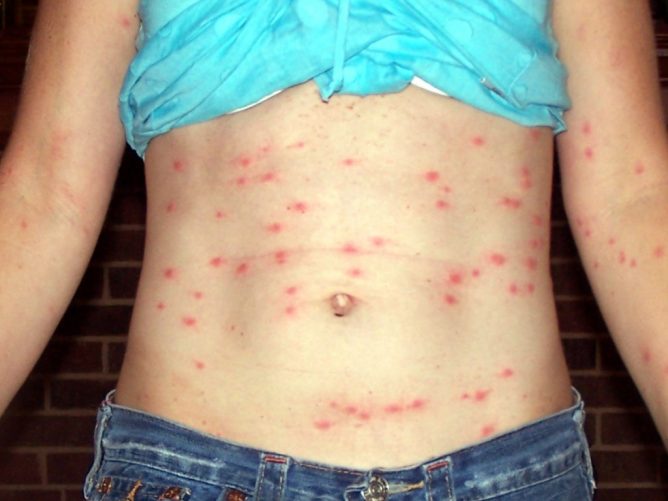 עקיצות פשפשים על פני השטח של החלק הקדמי של גוף האדם