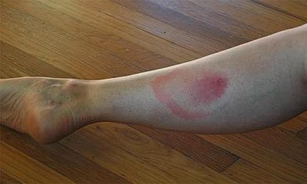 אתר נשיכה אדמומי על הרגל