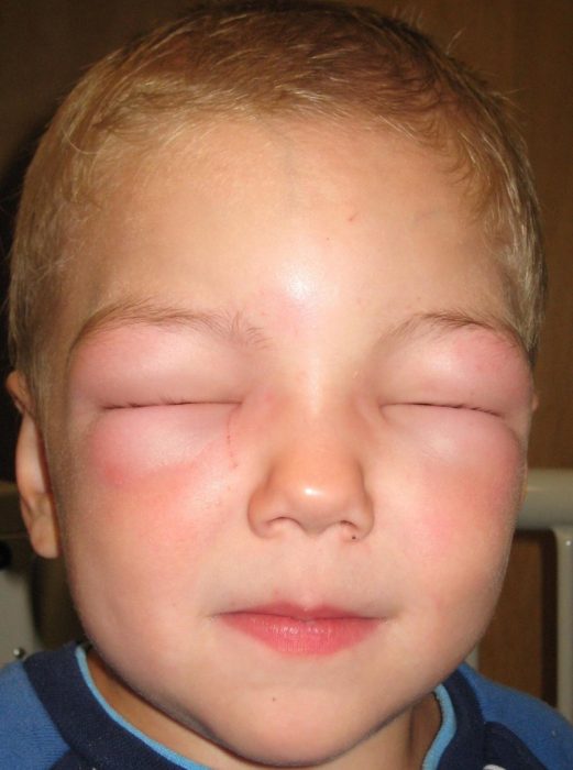 בצקת קווינקה אצל ילד