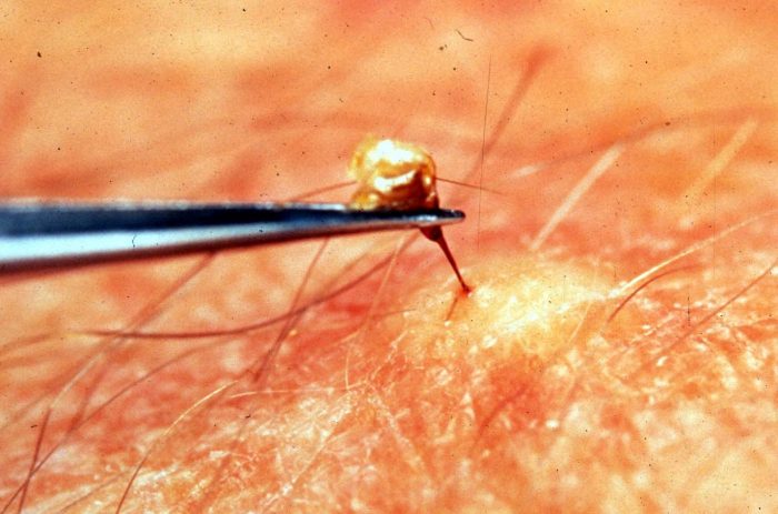 העוקץ מוסר מהעור בעזרת פינצטה.