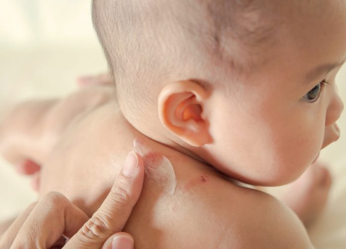 טיפול בנשיכה על עורו של תינוק