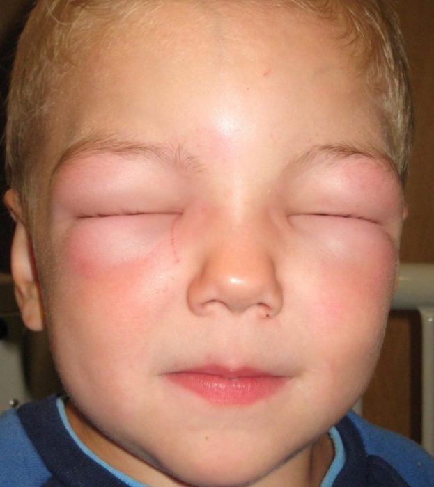 עיניו של הילד נפוחות