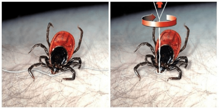 הסרת קרציה בעזרת חוט