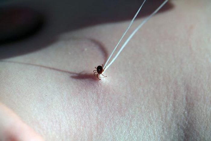 הסרת קרציה בעזרת חוט