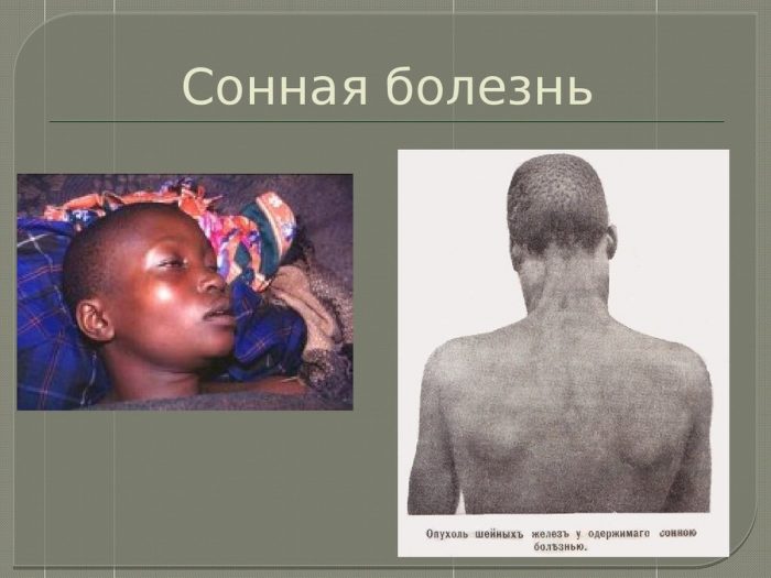 תסמינים של מחלת שינה