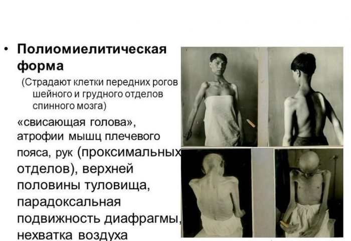 פוליו, צורה של דלקת המוח הנישאת על ידי קרציות