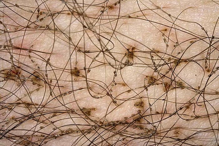 כיני ערווה וביצים על השיער