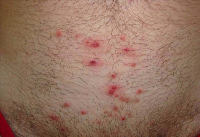 בטן תחתונה מכוסה בפריחה אדומה