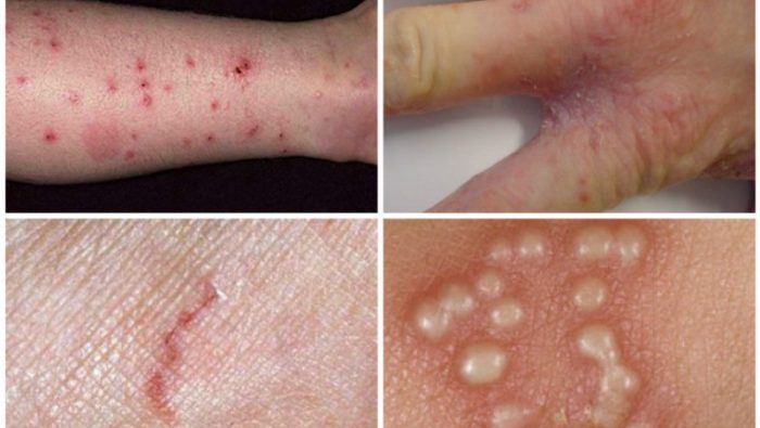 עקבות פעילות קרדית הגרדת