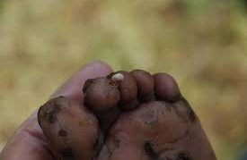 טונגיאסיס על הבוהן