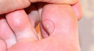 מיקום הבוהן