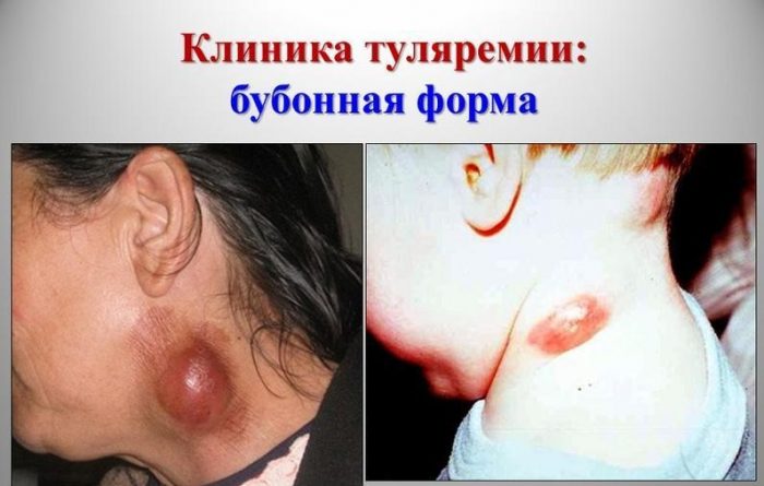 ביטויים של טולרמיה