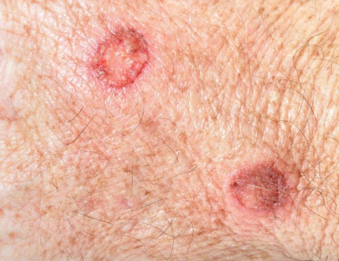 עקיצות קרדית גרדת