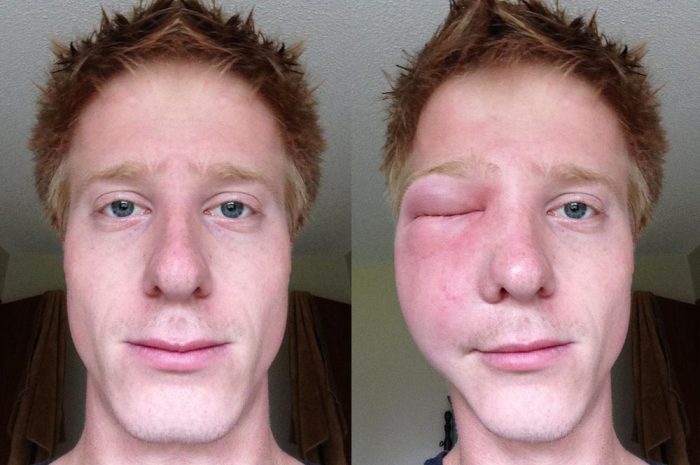 בצקת קווינקה