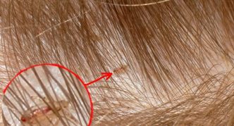 כינים בשיער