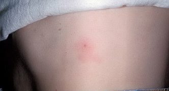 עקיצת קרציה