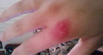 עקיצת עכביש