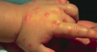 עקיצות פשפשים