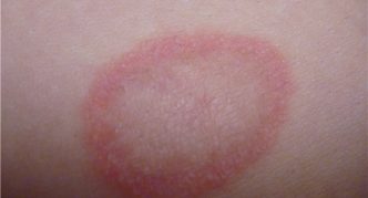 עקיצת דבורה