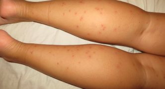 עקיצות פרעושים