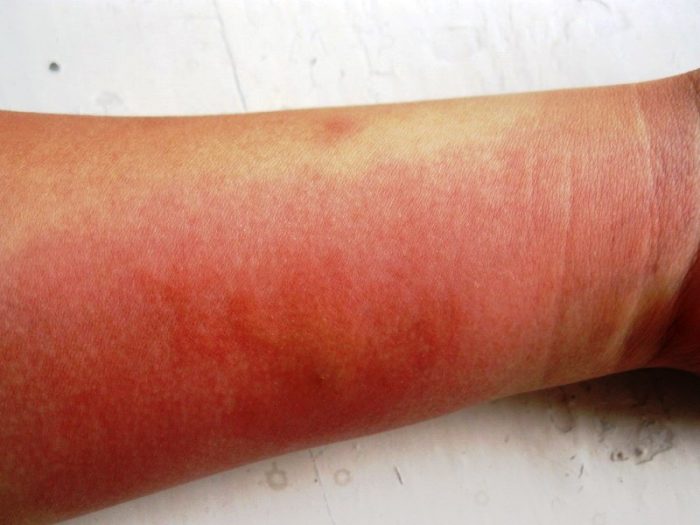 אלרגיה לעקיצת יתושים