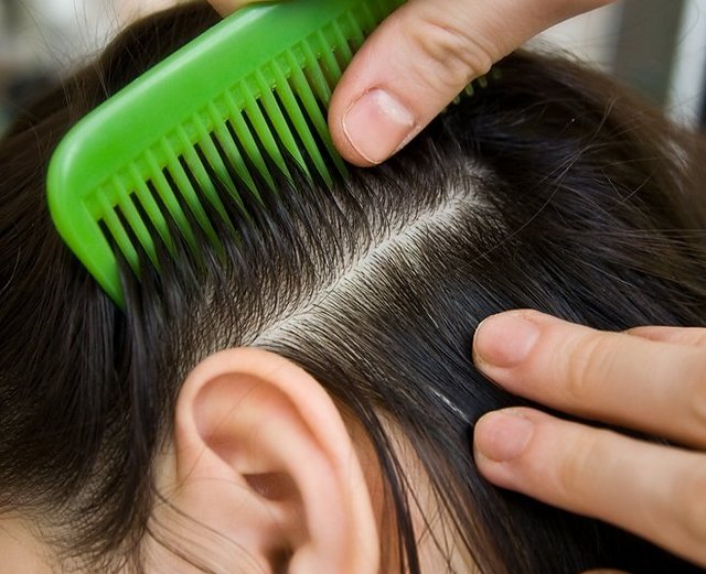 בדיקת ראשו של ילד לאיתור כינים