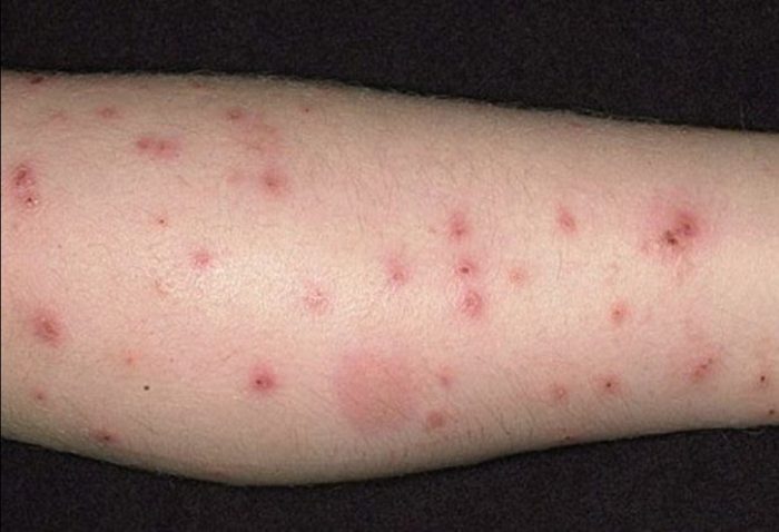 מספר נקודות נשיכה על העור