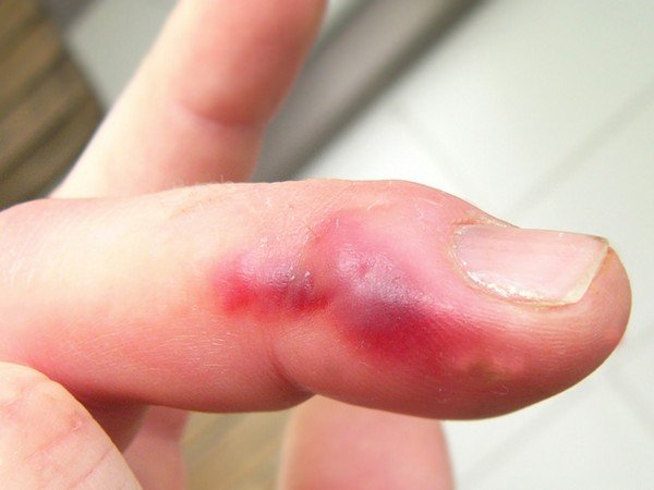 השלכות של נשיכת מרבה רגליים על האצבע