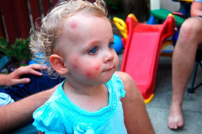 ילד עם עקיצות