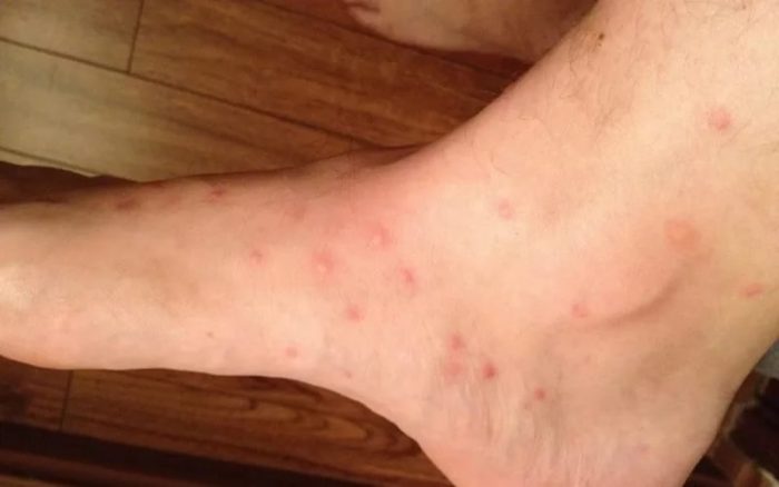 עקיצות פרעושים על הקרסול