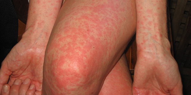 אלרגיה לפשפשים