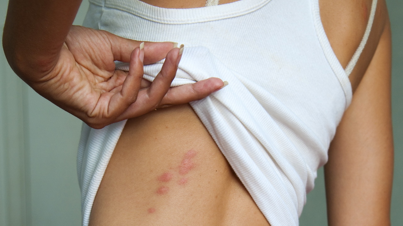 עקיצות פרעושים בבני אדם: תסמינים, טיפול ומניעה