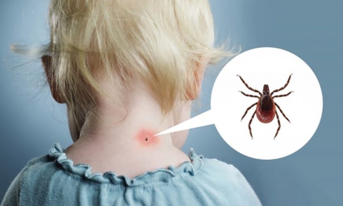 קרצייה על צווארה של ילדה