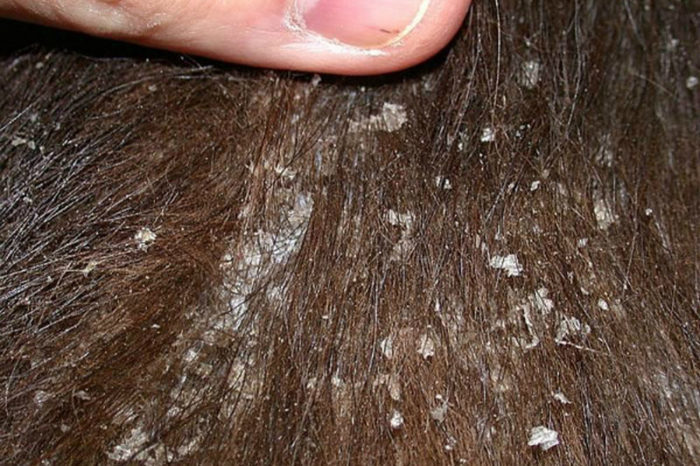 הצטברות גדולה של פתיתי עור על עור החתול